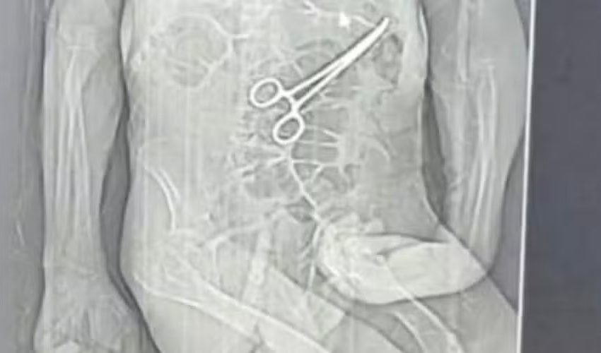  Morre idoso que teve instrumento cirúrgico esquecido dentro do corpo em MG