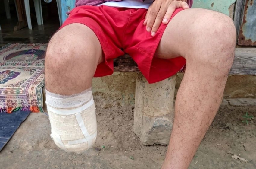 Homem condenado na Bahia por amputar o próprio pé em trama milionária de fraude de seguro