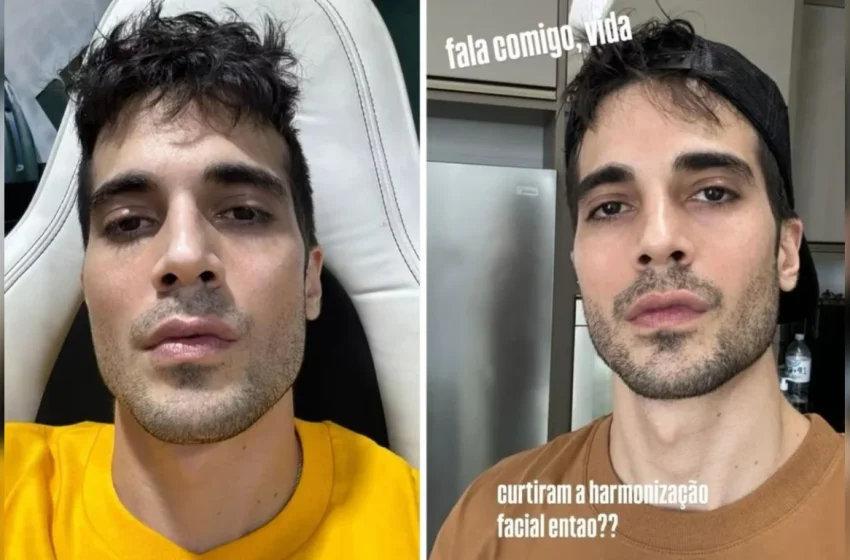 Fiuk exibe resultado de harmonização facial em meio a polêmicas sobre finanças